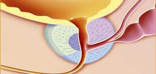 التهاب البروستاتا
