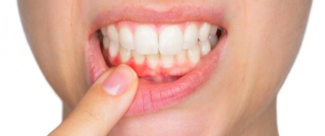 التهابات الأسنان