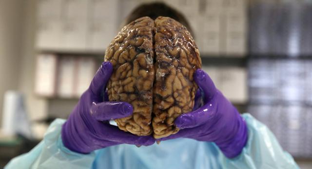 اكتشاف ”دودة عملاقة” داخل مخ رجل