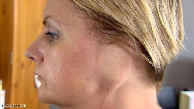 امرأة بريطانية تفقد أذنها بسبب ”حمامات الشمس”