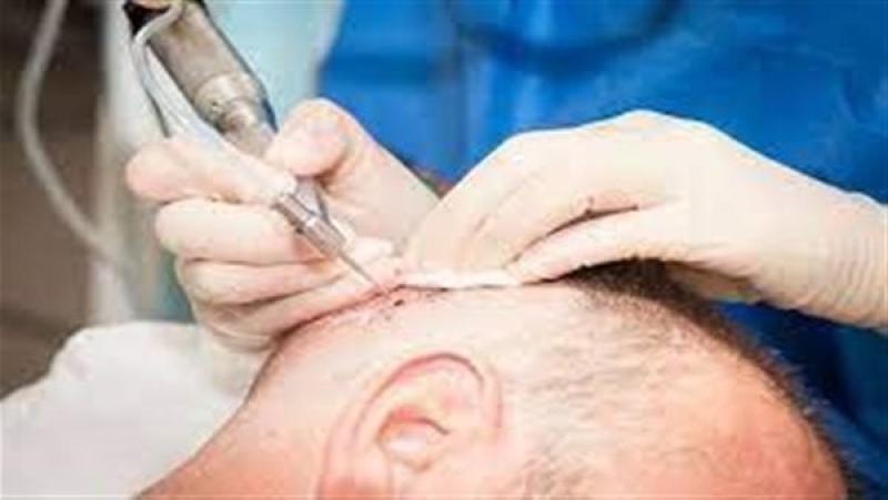 وفاة رجل بتعفن الدم بعد زراعة الشعر في الهند..ما مدى خطورة العملية ؟