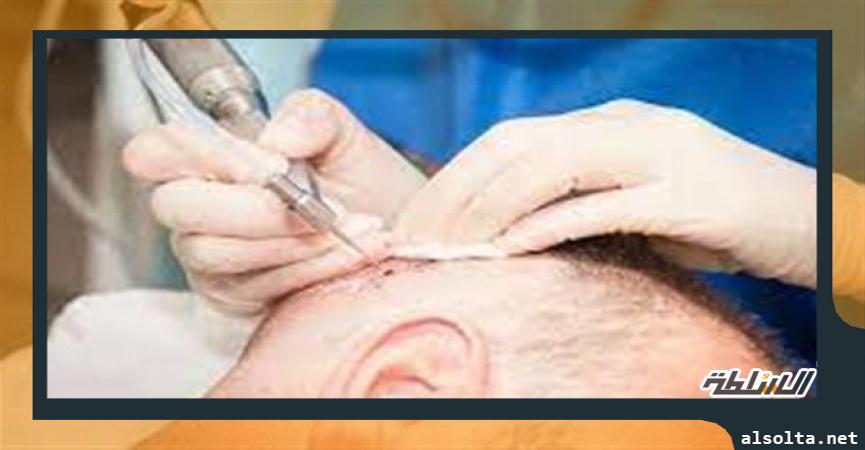 صحة وطب  زراعة شعر