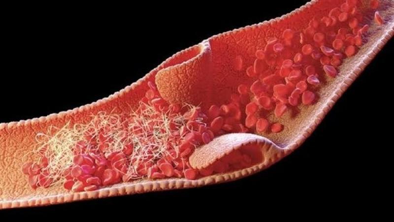 6 نصائح مهمة للوقاية من الإصابة بتجلط الدم
