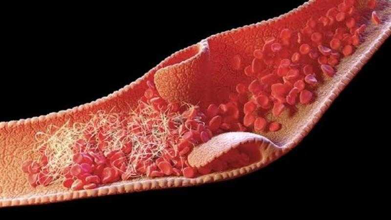 6 نصائح مهمة للوقاية من الإصابة بتجلط الدم