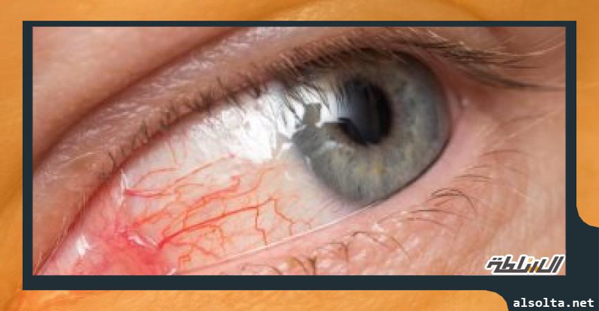 الإسعافات الأولية لإصابة العين